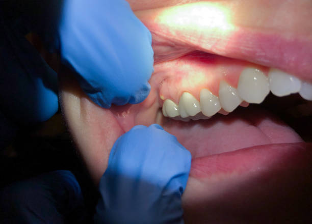 Best Emergency Treatment for Oral Infections in Key Largo, FL