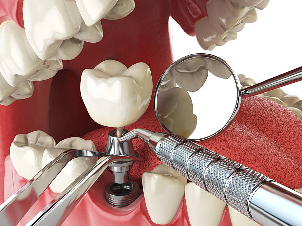 Best Knocked-Out Tooth (Avulsed Tooth) Treatment in Key Largo, FL